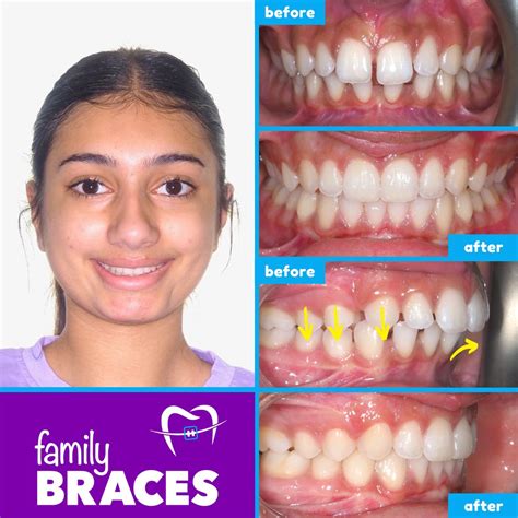 failed braces result|Solutions for Patients Unhappy with Their Orthodontic .
